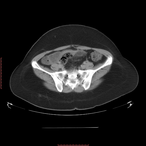 File:Bilateral ovarian serous cystadenocarcinoma with right ovarian torsion (Radiopaedia 32640-33611 A 32).jpg
