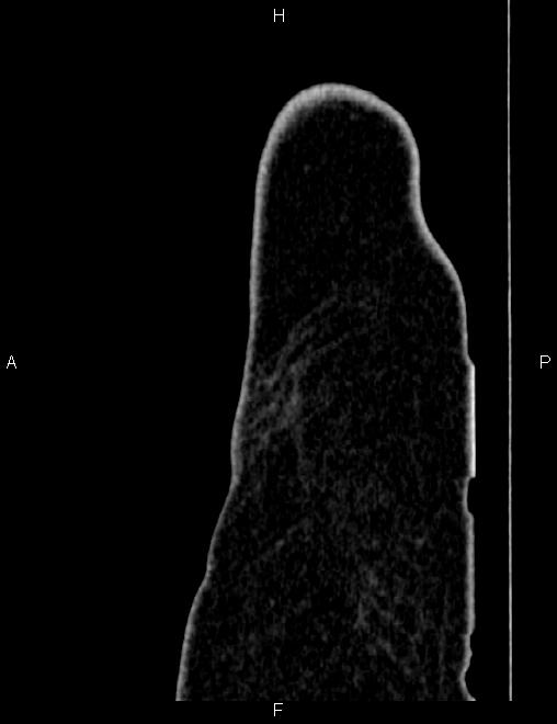 Bilateral ovarian teratoma (Radiopaedia 83131-97503 D 9).jpg