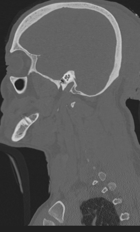 Bilateral perched facet joint (Radiopaedia 63149-71669 Sagittal bone window 70).jpg