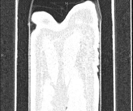 Bilateral pulmonary AVM (Radiopaedia 83134-97505 Coronal lung window 83).jpg