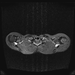File:Bilateral spinoglenoid notch ganglion cysts (Radiopaedia 29577-30082 E 6).jpg