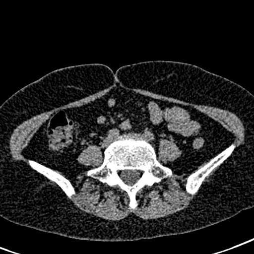 Bilateral staghorn calculi (Radiopaedia 59475-66842 Axial non-contrast 49).jpg