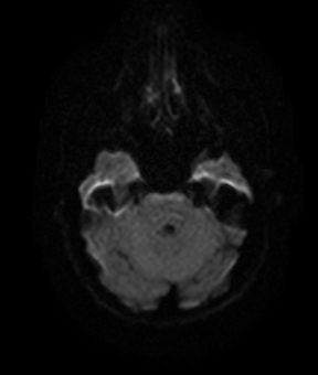 File:Bilateral thalamic gliomata (Radiopaedia 42538-45664 Axial DWI 7).jpg