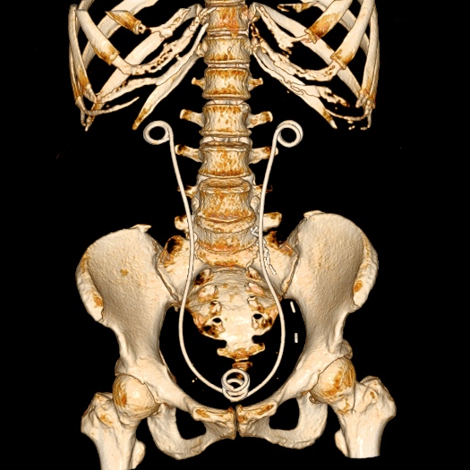 File:Bilateral ureteric stents (Radiopaedia 48795-53825 Coronal VRT 1).jpg
