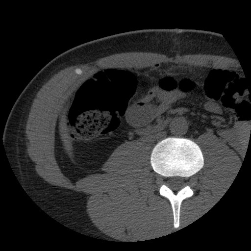 File:Bile leak from liver traumatic laceration (Radiopaedia 63463-72077 Axial Biliscopin 83).jpg