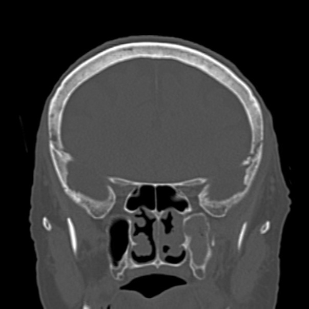 Biparietal osteodystrophy (Radiopaedia 46109-50463 Coronal bone window 38).jpg
