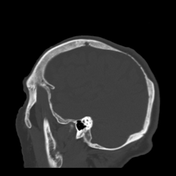 Biparietal osteodystrophy (Radiopaedia 46109-50463 Sagittal bone window 26).jpg