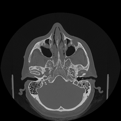 File:Bisphosphonate-related osteonecrosis of the jaw (Radiopaedia 71324-81642 Axial bone window 155).jpg