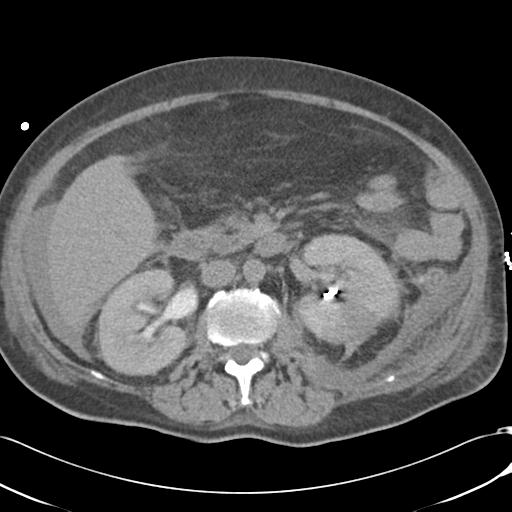 Bladder rupture post renal biopsy (Radiopaedia 30863-31572 Axial non-contrast 38).jpg