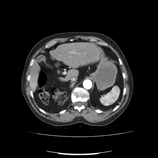 File:Bladder tumor detected on trauma CT (Radiopaedia 51809-57609 A 85).jpg