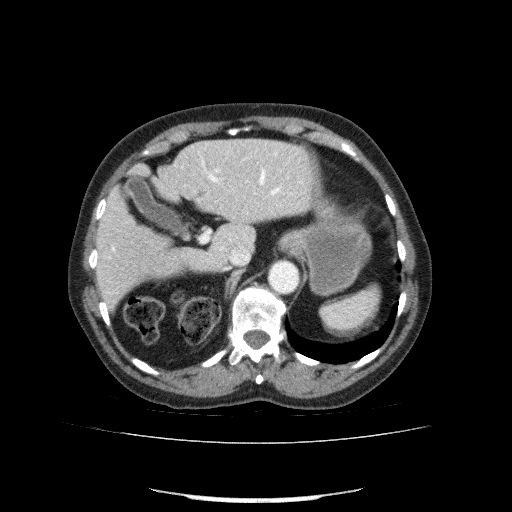 File:Bladder tumor detected on trauma CT (Radiopaedia 51809-57609 B 33).jpg