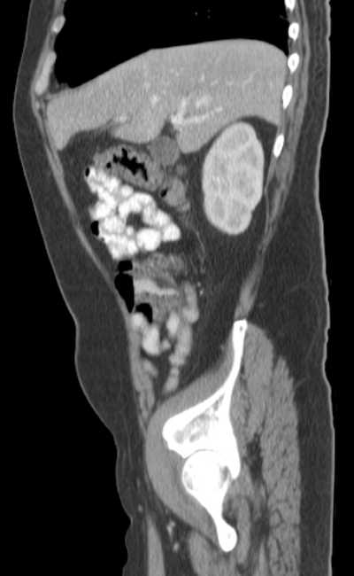 Bleeding duodenal ulcer and adenomyomatosis of gallbladder (Radiopaedia 61834-69861 C 24).jpg