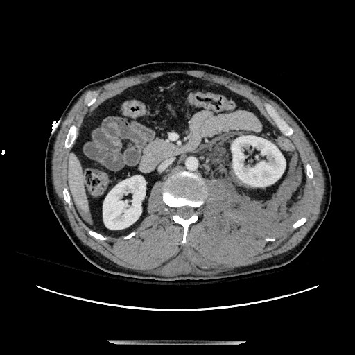 Blunt abdominal trauma with solid organ and musculoskelatal injury with active extravasation (Radiopaedia 68364-77895 A 62).jpg