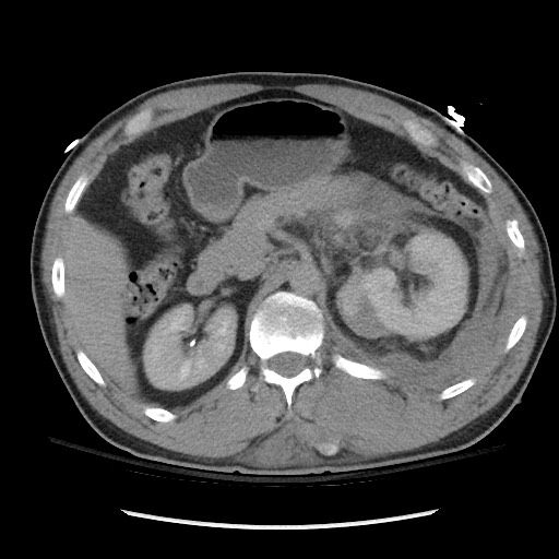 Blunt abdominal trauma with solid organ and musculoskelatal injury with active extravasation (Radiopaedia 68364-77895 Axial C+ delayed 48).jpg