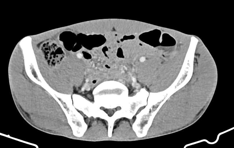 Blunt injury to the small bowel (Radiopaedia 74953-85987 A 145).jpg