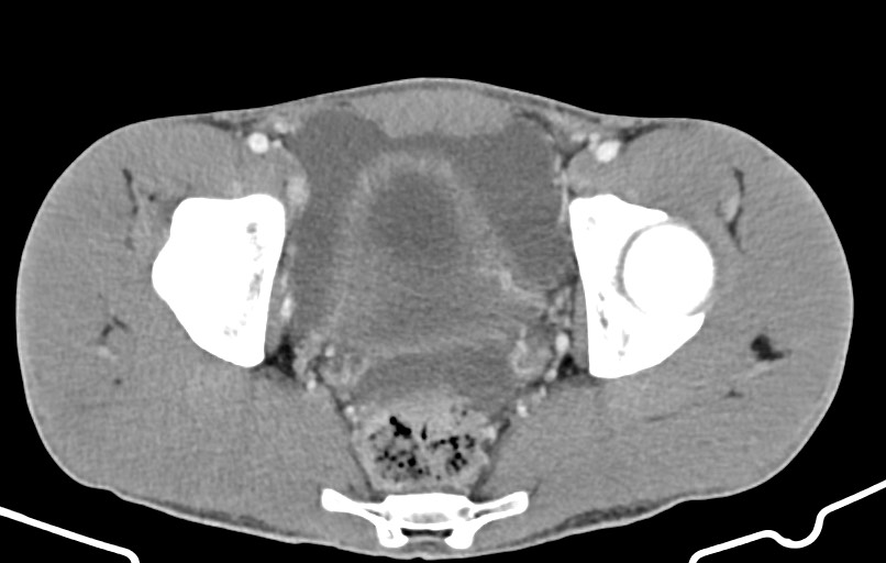 Blunt injury to the small bowel (Radiopaedia 74953-85987 A 174).jpg