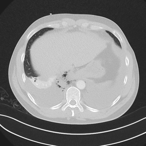 Boerhaave syndrome (Radiopaedia 39382-41660 Axial lung window 46).png