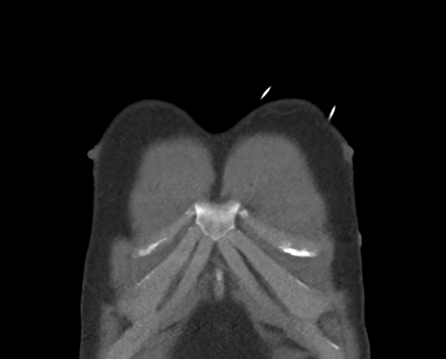 File:Boerhaave syndrome (Radiopaedia 39382-41660 C 10).png