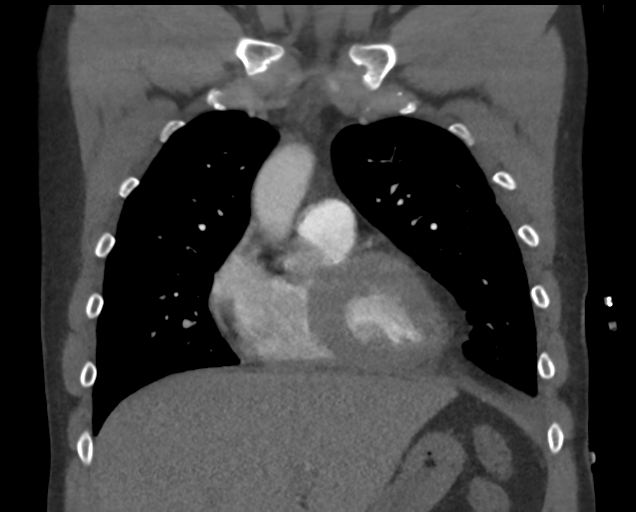 File:Boerhaave syndrome (Radiopaedia 39382-41660 C 30).png