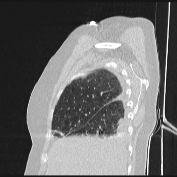 Boerhaave syndrome (Radiopaedia 45644-49799 Sagittal lung window 14).jpg