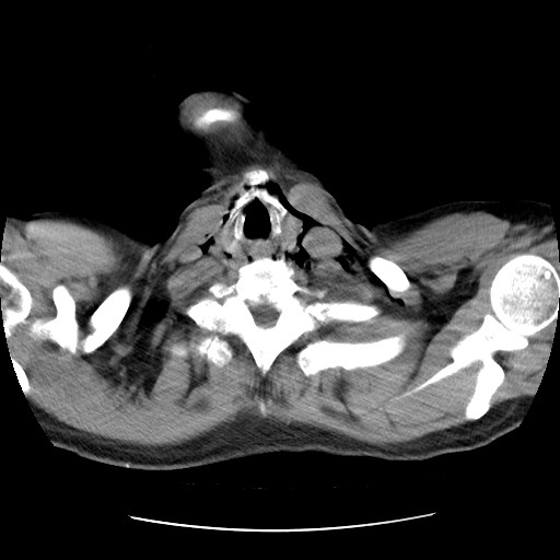 File:Boerhaave syndrome (Radiopaedia 59796-67310 Axial liver window 6).jpg