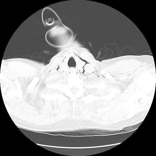 Boerhaave syndrome (Radiopaedia 59796-67310 Axial lung window 7).jpg