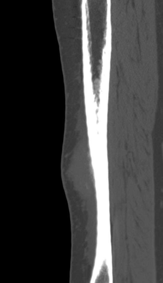 Bone metastasis - tibia (Radiopaedia 57665-64609 Sagittal bone window 50).jpg