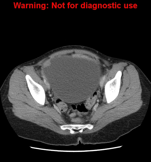 Borderline mucinous cystadenoma of ovary (Radiopaedia 25586-25767 A 97).jpg