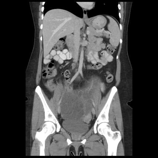 Borderline mucinous tumor (ovary) (Radiopaedia 78228-90808 C 28).jpg