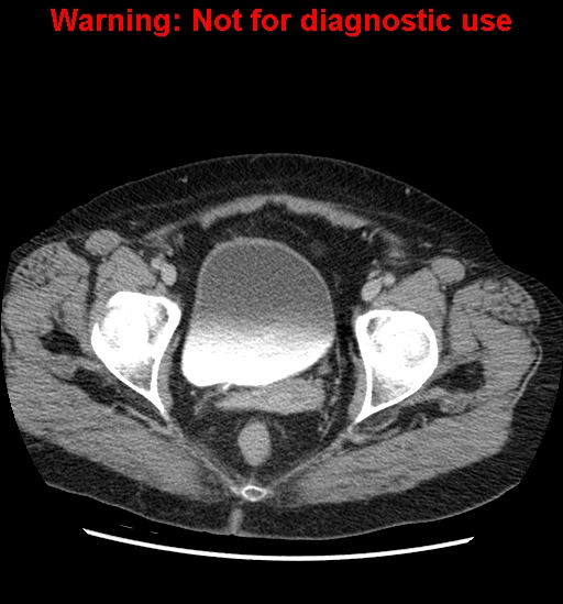 File:Bosniak renal cyst - type II (Radiopaedia 23404-23468 F 62).jpg