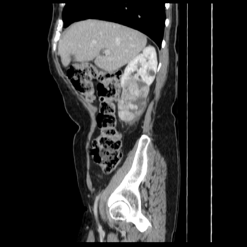 Bosniak renal cyst - type IV (Radiopaedia 22929-22953 G 19).jpg