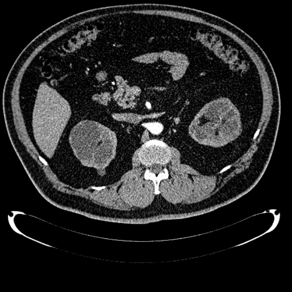 Bosniak renal cyst - type IV (Radiopaedia 24244-24518 B 127).jpg