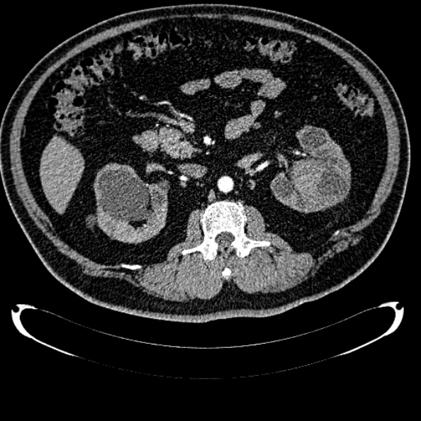 Bosniak renal cyst - type IV (Radiopaedia 24244-24518 B 141).jpg