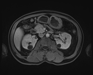 Bouveret syndrome (Radiopaedia 61017-68856 Axial T1 C+ fat sat 43).jpg