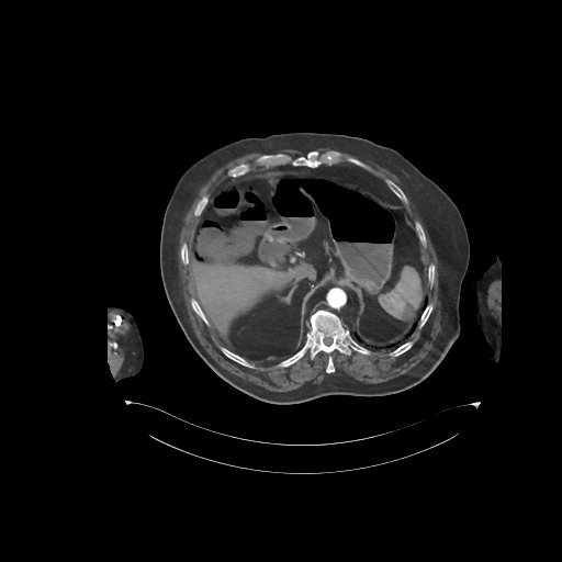 File:Bowel ischemia secondary to SMA occlusion with extensive portomesenteric venous gas (Radiopaedia 54656-60871 A 61).jpg