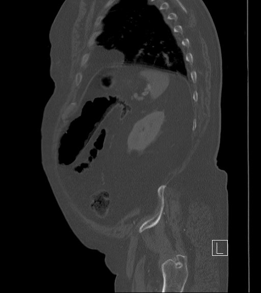 File:Bowel ischemia secondary to SMA occlusion with extensive portomesenteric venous gas (Radiopaedia 54656-60871 Sagittal bone window 21).jpg
