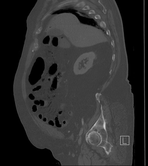 Bowel ischemia secondary to SMA occlusion with extensive portomesenteric venous gas (Radiopaedia 54656-60871 Sagittal bone window 83).jpg