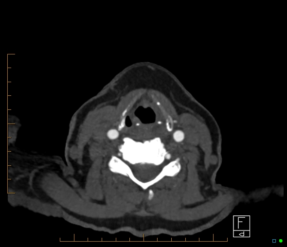 Brachiocephalic trunk stenosis (Radiopaedia 87242-103519 A 103).jpg