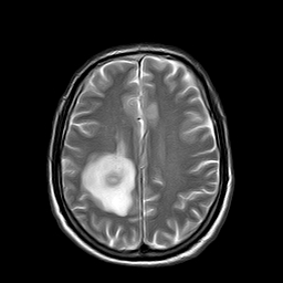 File:Brain abscess complicated by intraventricular rupture and ventriculitis (Radiopaedia 82434-96571 Axial T2 17).jpg