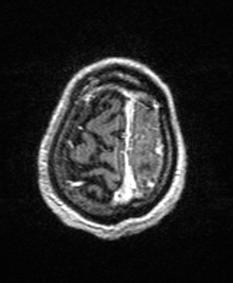 Brain abscess with dual rim sign (Radiopaedia 87566-103938 Axial T1 C+ 144).jpg
