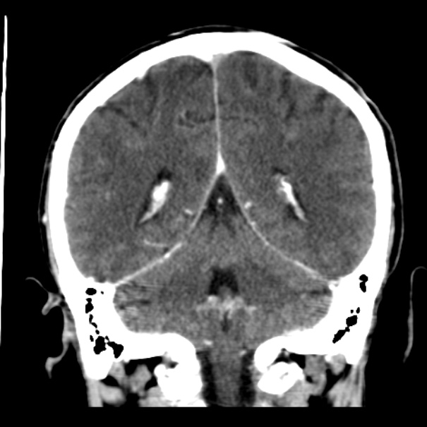 Brain metastases from lung cancer (Radiopaedia 24480-24781 Coronal C+ delayed 43).jpg