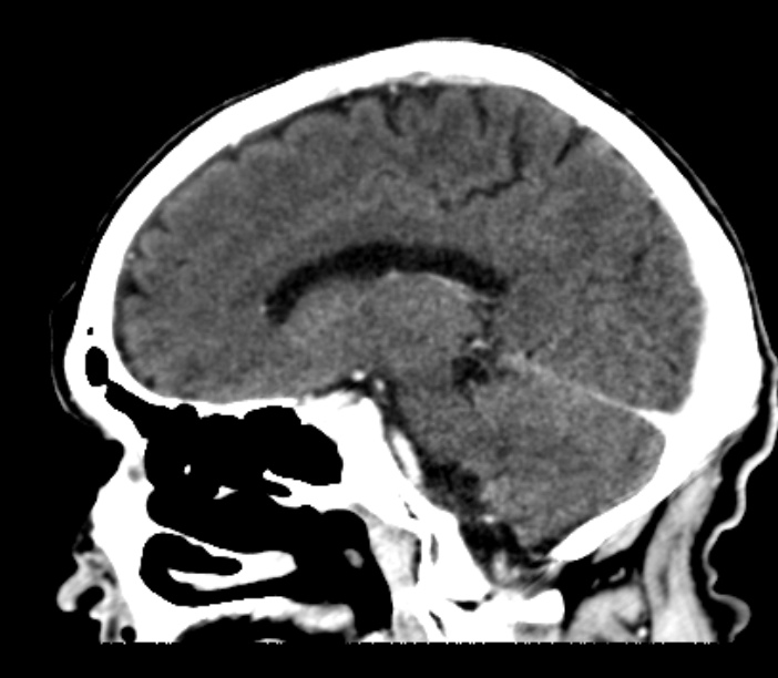 Brain metastases from lung cancer (Radiopaedia 27849-28092 Sagittal C+ delayed 36).jpg