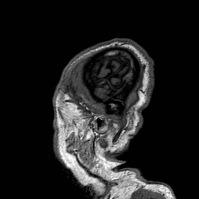Brain metastases from lung cancer (Radiopaedia 83839-99028 Sagittal T1 125).jpg