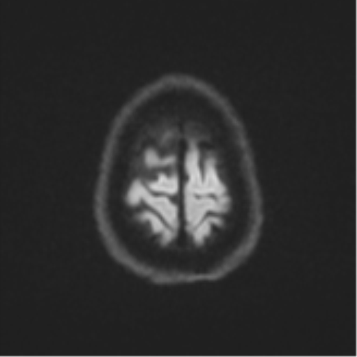 Brain metastasis (large cystic mass) (Radiopaedia 47497-52107 Axial DWI 53).png