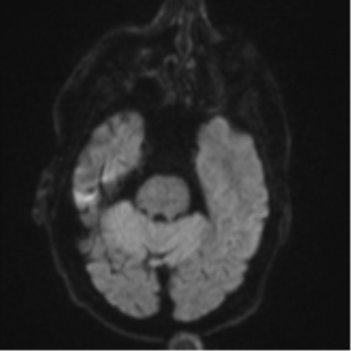 Brain metastasis (lung cancer) (Radiopaedia 48289-53179 Axial DWI 36).png