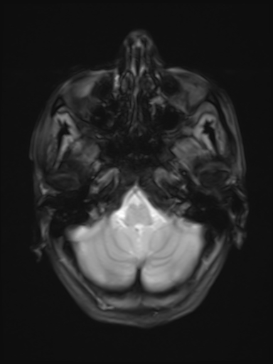 File:Brain metastasis as initial presentation of non-small cell lung cancer (Radiopaedia 65122-74126 Axial T2* 5).jpg