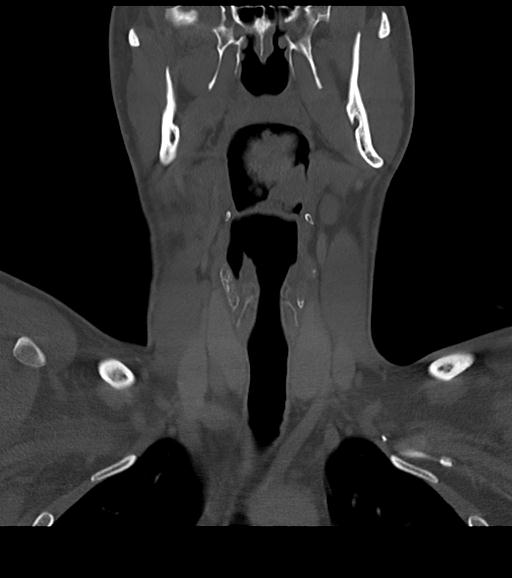 Branchial cleft cyst (Radiopaedia 31167-31875 Coronal bone window 30).jpg