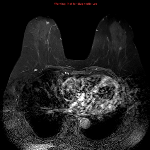 File:Breast carcinoma (multicentric multifocal in mammary Paget disease) (Radiopaedia 50966-56512 Axial T1 C+ fat sat 5).jpg