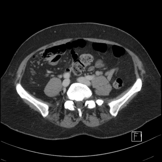 File:Breast metastases from renal cell cancer (Radiopaedia 79220-92225 C 75).jpg