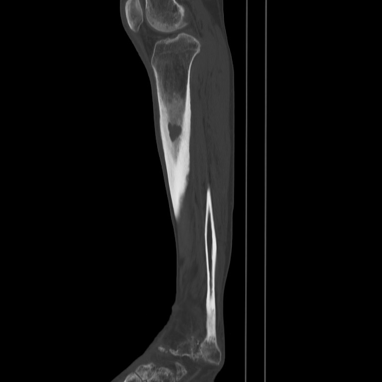 Brodie abscess - tibia (Radiopaedia 66028-75204 Sagittal bone window 47).jpg